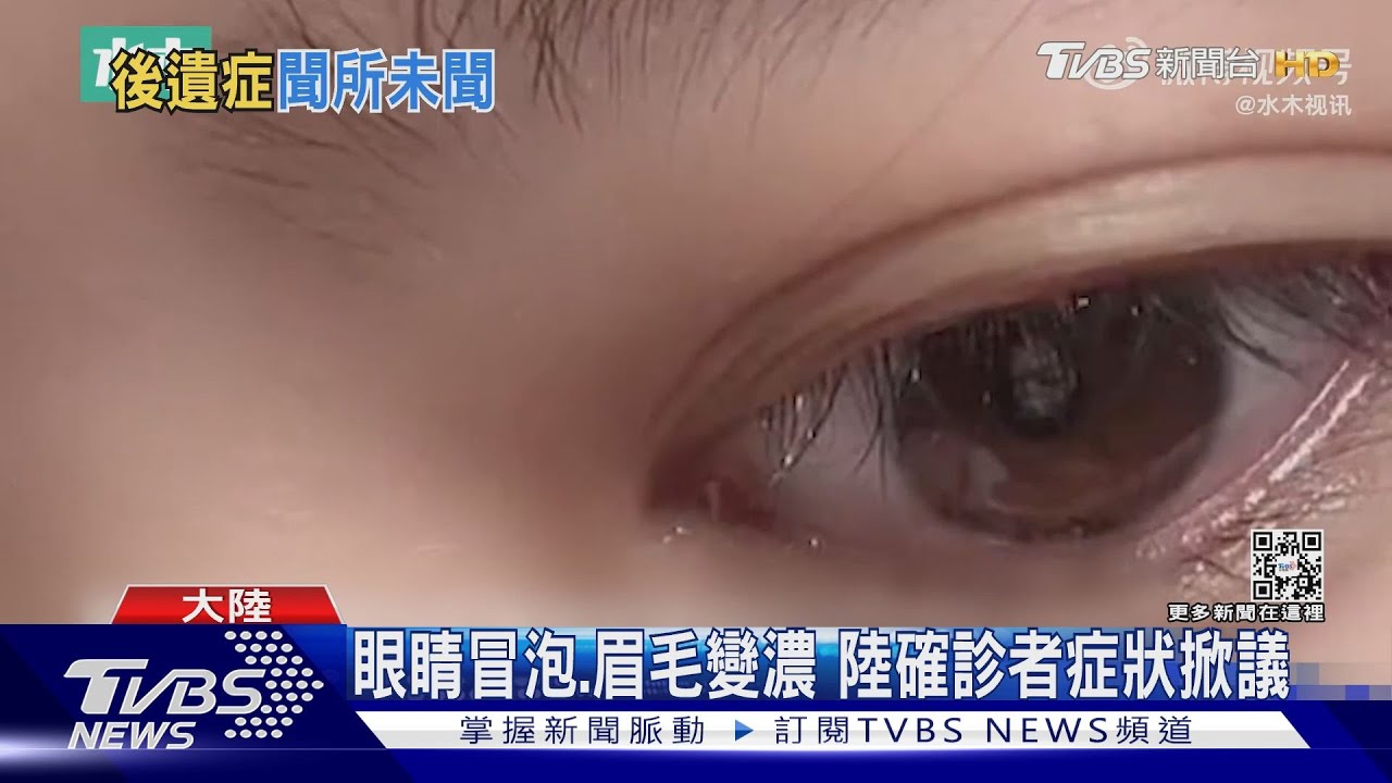 眼睛冒泡、眉毛變濃 陸確診者症狀掀議