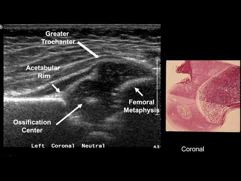 Imaging in developmental hip dysplasia