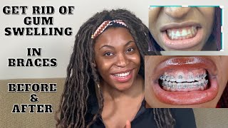 How to get rid of Gum swelling in braces