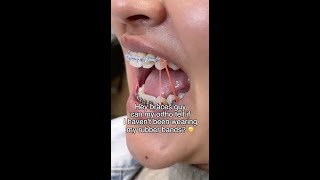Download lagu Can Orthodontists Tell If You’re Lying About Wearing Rubber Bands? 😅 mp3