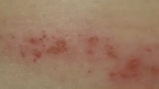 Scabies mystery solved?