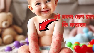 বাচ্চাদের শরিরের রেশ নিয়ে আর নয় চিন্তা ১ মিনিটেই হবে সমাধান।Baby rash treatment at home