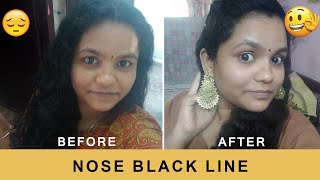 NOSE BLACK LINE REMOVE  II  GET RID OF NOSE BLACK LINE II with simple natural home remedies