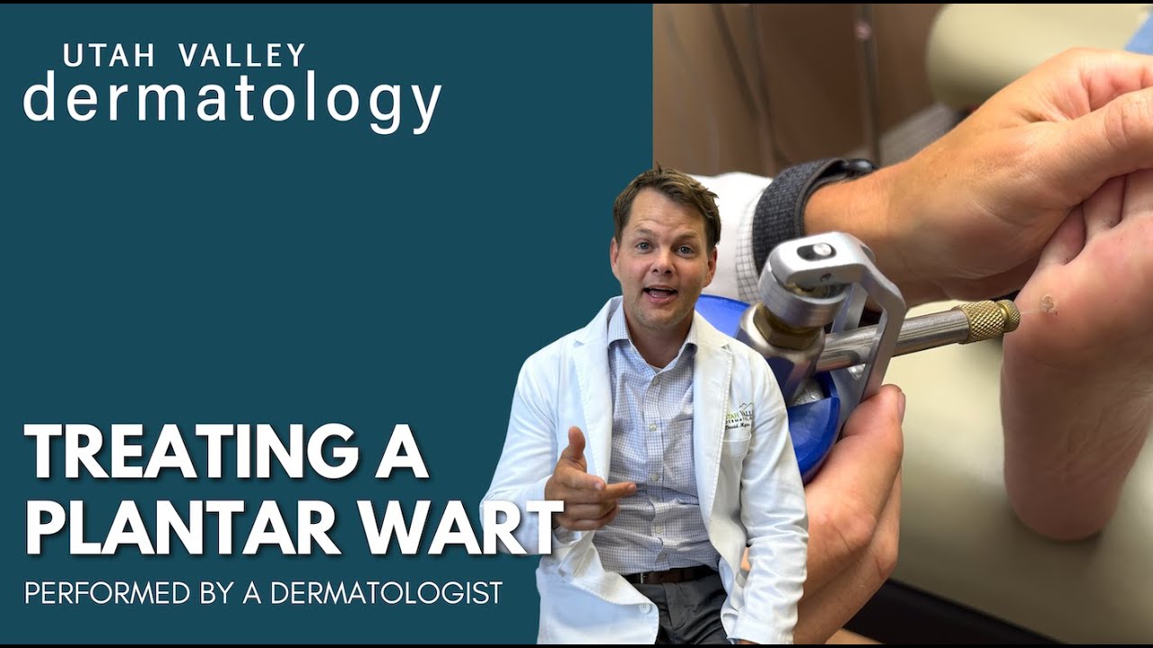 Treating a Plantar Wart | Utah Valley Dermatology
