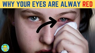 Reasons Why Your Eyes Are Red | Get Rid Of Red Eyes