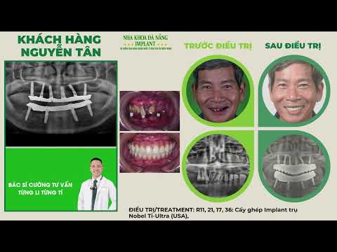 CẤY GHÉP IMPLANT KHÔNG ĐAU - AN TOÀN - HIỆU QUẢ TẠI NHA KHOA ĐÀ NẴNG IMPLANT