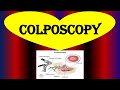 What is a Colposcopy? | Colposcopy : Biopsy, Purpose, Procedure, Risks and Results