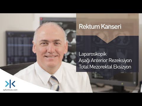 Laparoskopik Aşağı Anterior Rezeksiyon - Total Mezorektal Eksizyon - Rektum Kanseri