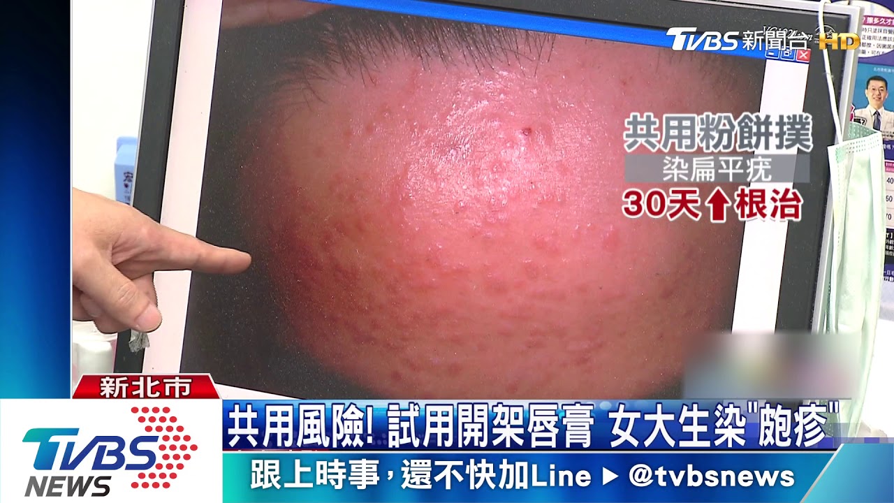 共用風險!試用開架唇膏 女大生染「皰疹」