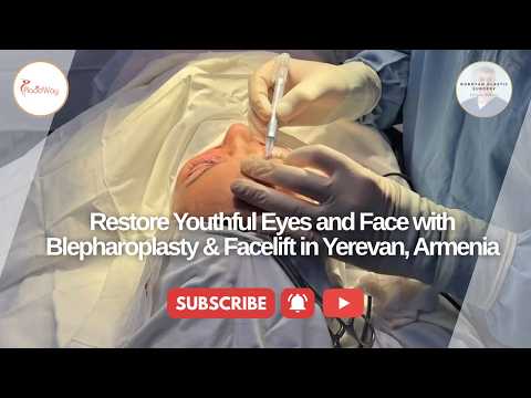 Restore Youthful Eyes and Face with Blepharoplasty & Facelift in Yerevan, Armenia