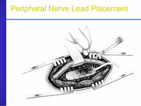 Dr. Georgios Matis - Neuromodulation - Advanced Pain Therapies - CRPS & PVD