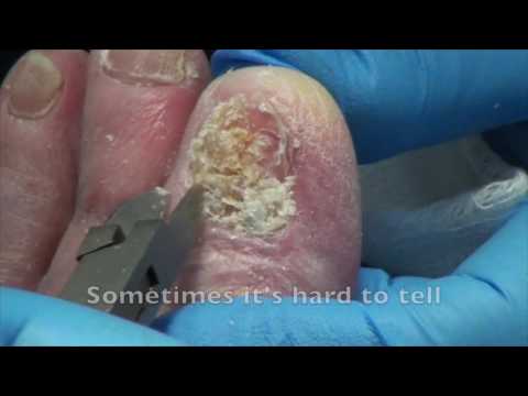 Fungus stop video advertising Ang pinakamahusay na lunas para sa mga halamang-singaw sa daliri ng paa kuko review