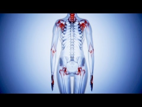 Artroza tratamentului articulațiilor șoldului și genunchiului