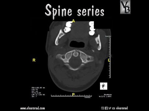 Jefferson fracture - Spine series
