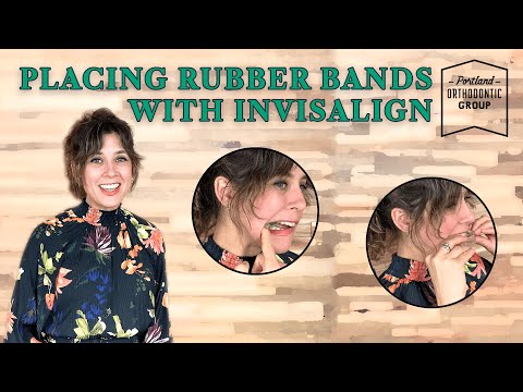 Placing Rubberbands with Invisalign