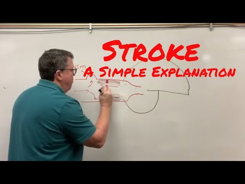 Stroke (Cerebrovascular Accident) A Simple Explanation