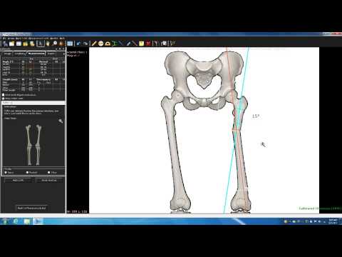 TraumaCad Deformity Course Part 2A - Deformity Correction