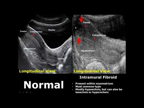 Uterus Ultrasound Normal Vs Abnormal Image Appearances Comparison | Uterine Pathologies USG