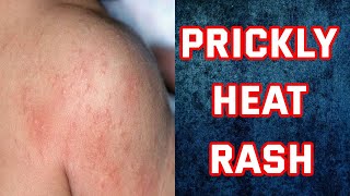 Heat Rash Home Remedies | How To Get Rid Of Heat Rash Quickly