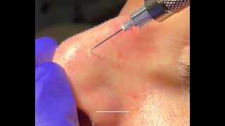 Treatment for Telangiectasia (Spider Veins) on the Nose | Dr. Brandon Beal