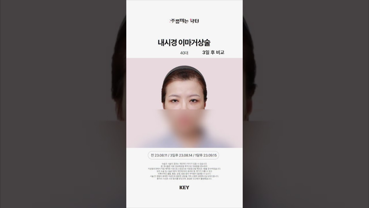 40대 이마거상술 3일후 모습 / 대구 이마거상 대구키성형외과