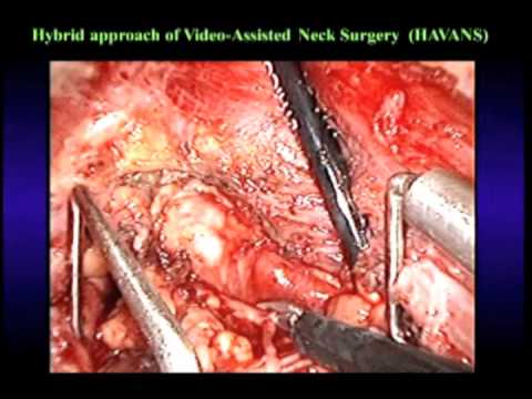 Hybrid Approach Of Video Assisted Neck Surgery 