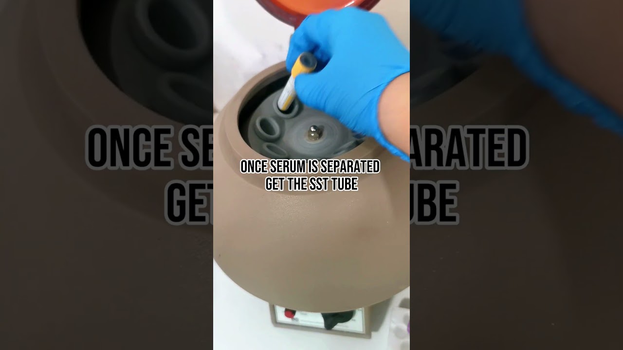 HBsAg Screening Test #laboratory #medtech #medtechstudent #mls #cls #hbsagkit #hepatitisb #serology