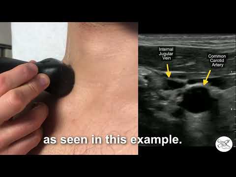 Identifying Jugular Venous Distension (JVD) with POCUS