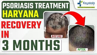Scalp Psoriasis Treatment | 3 Months Recovery | How to Cure Scalp Psoriasis Permanently