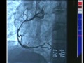 Cardiac Cath with Angioplasty