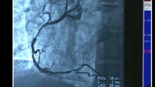 Cardiac Cath with Angioplasty