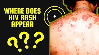 Where does HIV Rash Appear ?? - Skin Conditions Associated with HIV