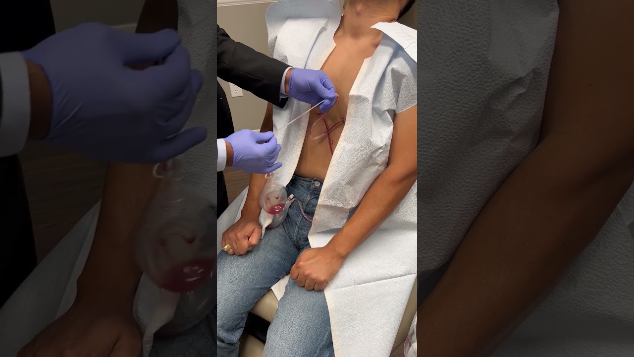 Postoperative Video Thumbnail