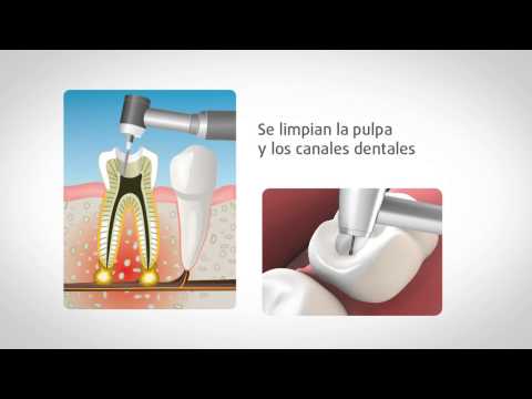 Endodoncia: ¿cómo se realiza?