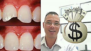 QUANTO CUSTA uma RESTAURAÇÃO | OBTURAÇÃO no dente VOU REVELAR O PREÇO!