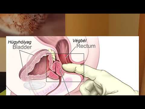 Prostatitis sb