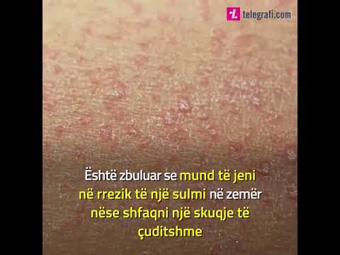 Disa ndryshime në lëkurë mund të jenë shenja paralajmëruese të sulmit në zemër