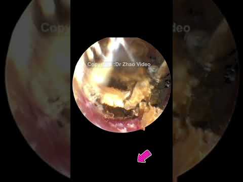 EAR WAX REMOVAL #Shorts #775