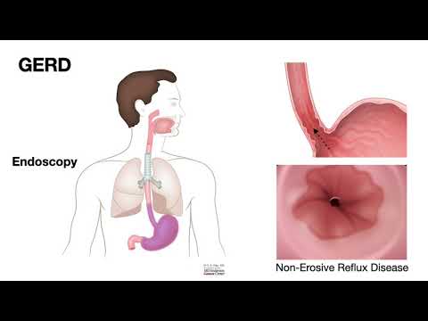 HCC 1475-2b-Pathology of Esophagus - Erosive Esophagitis