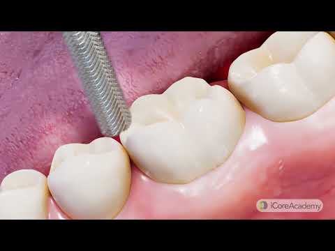 Mastering Crown Post-Op Care | Your Essential Guide to a Healthy Recovery