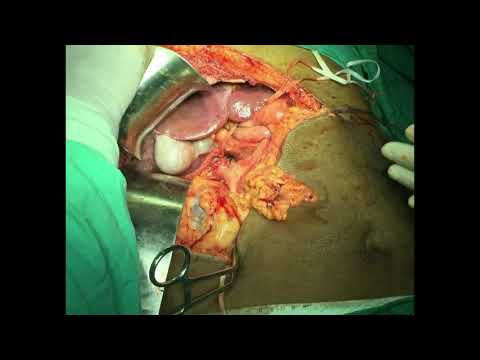 Renal Cell carcinoma with infrahepatic IVC thrombus