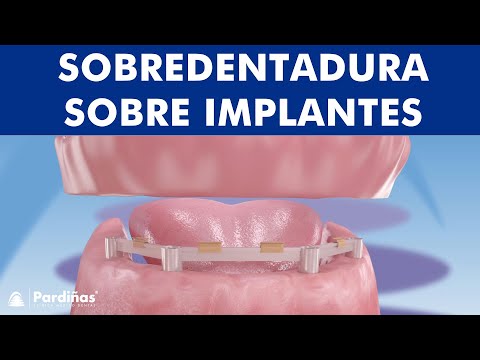 Sobredentadura sobre implante dentário ©