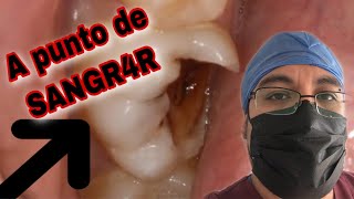 👄Caries CERCA del NERVIO 🚨 (bases para protección pulpar)💙