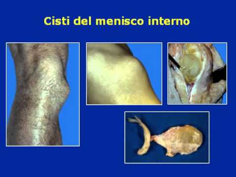 Ginocchio morbido benda Cervicale IRR osteocondrosi toracica