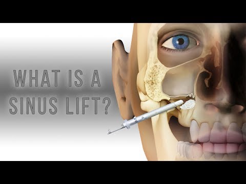 What is a sinus lift?
