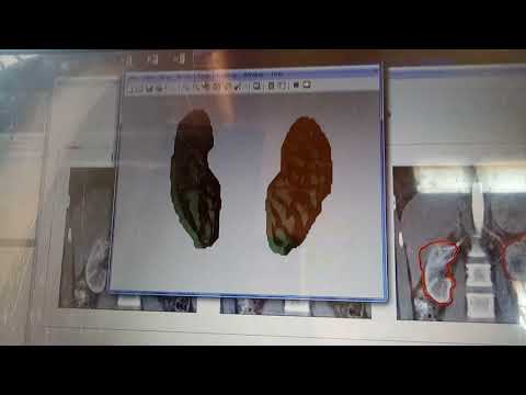 Segmentation driven image registration application to 4D DCE MRI recording of moving kidneys