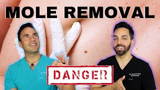 HOW TO REMOVE AN UNWANTED MOLE | DERMATOLOGIST PERSPECTIVE
