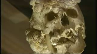 Joseph 'John' Merrick - let him rest in peace (UK) - BBC London News - 9th June 2016