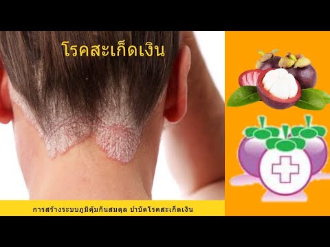 โรคสะเก็ดเงินเป็นผิว รักษากลากหยุดแห้ง
