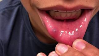 Popping a Lip Cyst?  Mucocele: Causes, Symptoms, and Treatment (Extended)